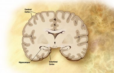 Prostate cancer treatment linked to Alzheimer’s