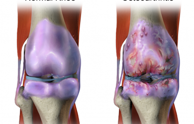 Joint lubricating fluid plays key role in osteoarthritic pain